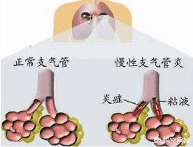 奔炎拍
:支气管炎和肺炎的区别是什么？