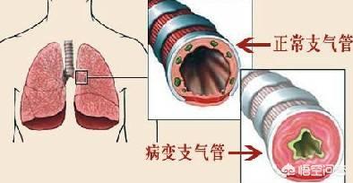 奔炎拍
:支气管炎和肺炎的区别是什么？