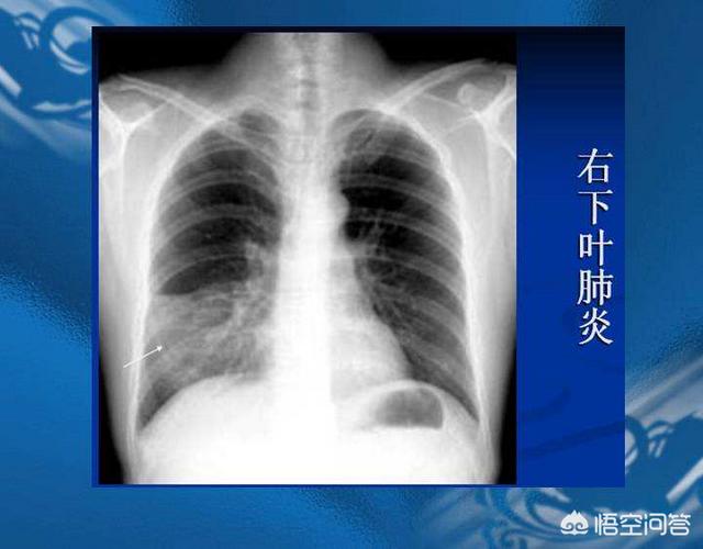 奔炎拍
:支气管炎和肺炎的区别是什么？