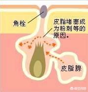 清理黑头视频
:有效去除黑头的方式有哪些？