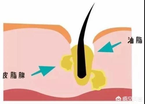 清理黑头视频
:有效去除黑头的方式有哪些？